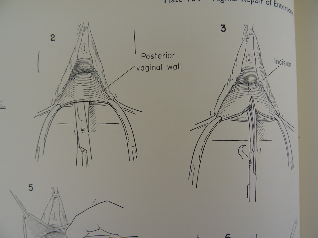 An atlas of pelvic operations 1953 - Afbeelding 16